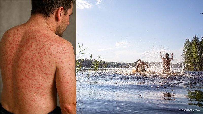 Combien de temps faut-il rester dans l'eau pour attraper la dermatite du baigneur et comment l'éviter cet été ?