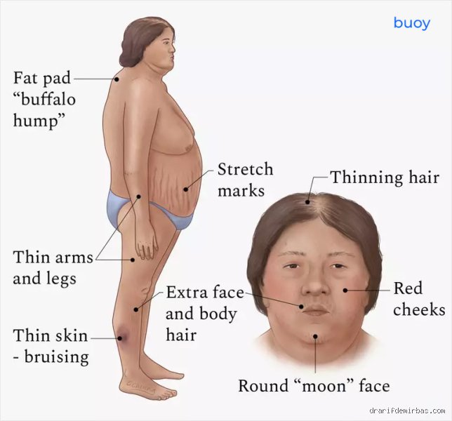 Combien de temps le syndrome de Cushing peut-il rester non diagnostiqué ? La réalité brutale d'une errance médicale interminable