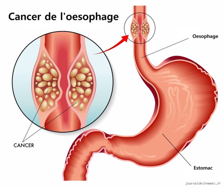 Combien de temps peut-on être porteur d'un cancer de l'œsophage avant de le savoir sans que le diagnostic ne tombe ?