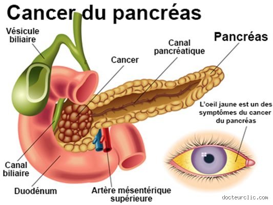 Comment ai-je découvert mon cancer du pancréas ? Les signaux d'alerte et le parcours du diagnostic précoce expliqués