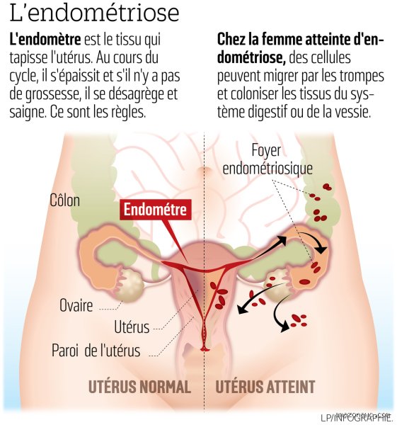 Comment ai-je guéri de l'endométriose ? Le récit sans filtre d'un parcours médical et holistique pour reprendre vie
