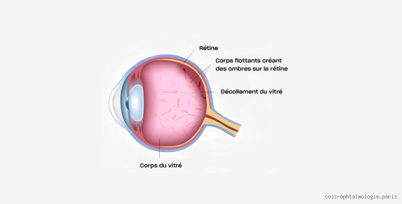 Comment améliorer le vitré de l'œil ?