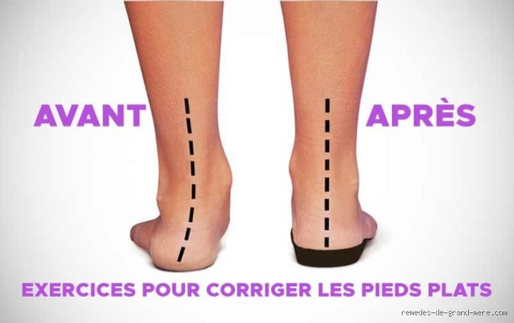 Comment avoir les pieds arqués ?
