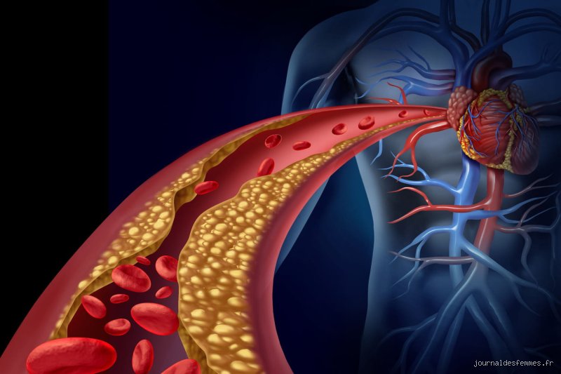 Comment déboucher une artère obstruée à 100 % ? Les nouvelles frontières de la cardiologie interventionnelle face aux occlusions totales chroniques