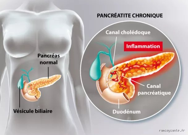 Comment débute une pancréatite ? Comprendre le mécanisme d'alerte et les premiers signes de l'inflammation du pancréas