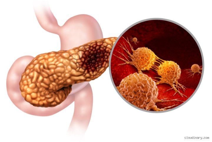 Comment dépister précocement le cancer du pancréas ? Stratégies, signaux faibles et réalités médicales d'un défi diagnostique majeur
