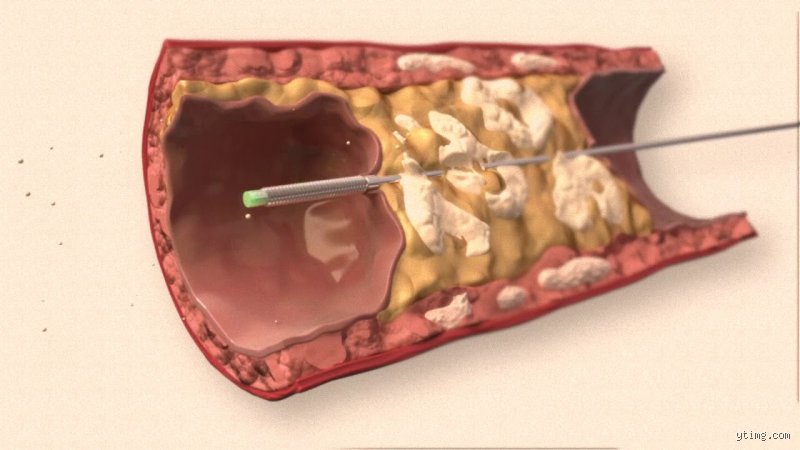 Comment enlever le calcaire des artères ? La vérité scientifique sur les méthodes de débouchage vasculaire actuelles