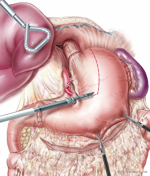 Comment enlever une tumeur à l'œsophage ? Du diagnostic à l'exérèse chirurgicale, le guide complet d'un parcours complexe