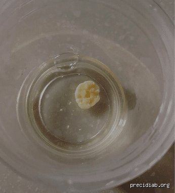 Comment est l'urine du diabétique ? Tout ce qu'il faut savoir sur les signes invisibles qui s'échappent par les reins