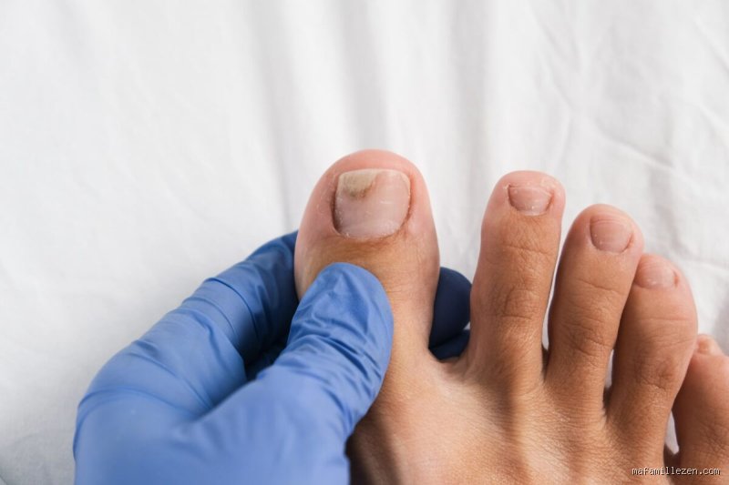 Comment éviter la mycose de la piscine et protéger durablement vos pieds contre les champignons cutanés tenaces