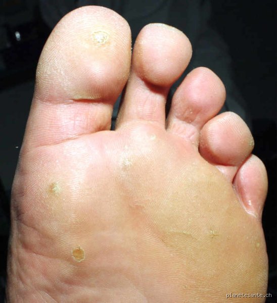 Comment éviter les mycoses à la piscine : le guide expert pour protéger vos pieds sans sacrifier vos longueurs