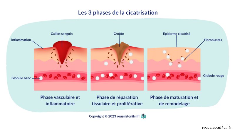 Comment faire cicatriser une plaie profonde ?