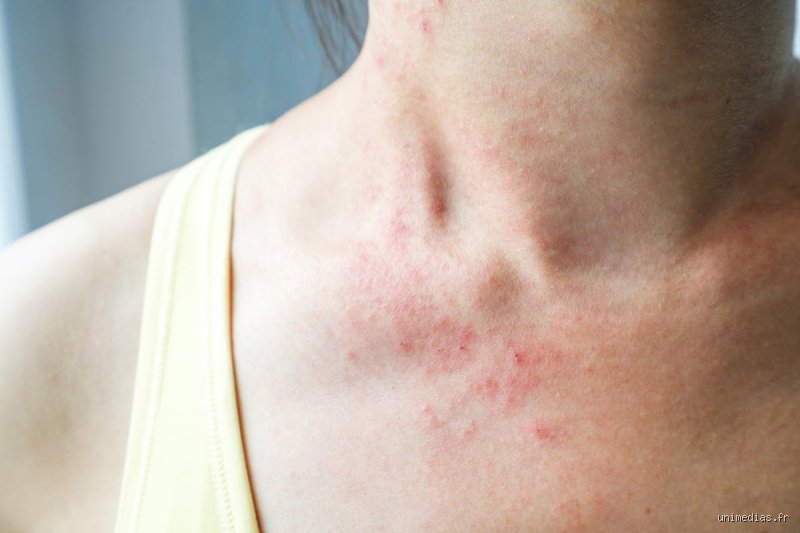 Comment faire disparaître l'eczéma en 2 jours ?
