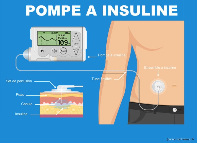 Comment faire fonctionner à nouveau le pancréas ? Les avancées médicales pour réactiver l’insuline et vaincre le diabète