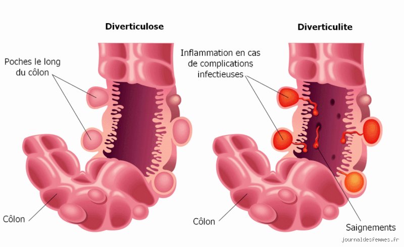 Comment faire la différence entre une diverticulite et le syndrome du côlon irritable : le guide pour ne plus confondre urgence et inconfort