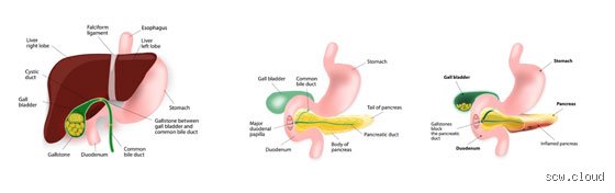 Comment faire la différence entre une gastrite et une pancréatite : le guide expert pour ne plus confondre ces douleurs abdominales