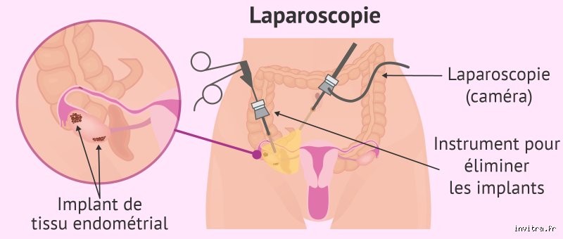 Comment faire le test d'endométriose : le guide complet pour enfin mettre un nom sur vos douleurs chroniques
