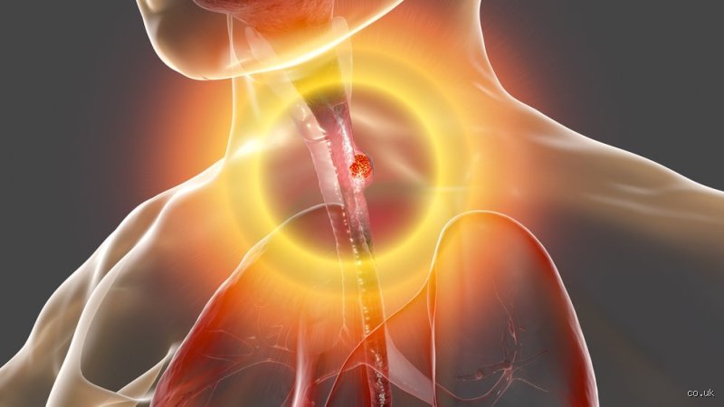 Comment j'ai découvert mon cancer de l'œsophage : les signaux d'alarme et le parcours diagnostic expliqué par des experts