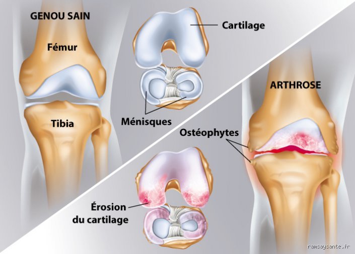 Comment lubrifier le cartilage de mon genou ?