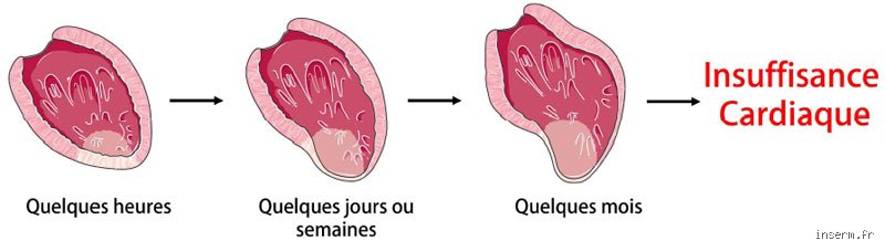 Comment muscler son cœur après un infarctus sans prendre de risques inutiles pour sa santé cardio-vasculaire ?