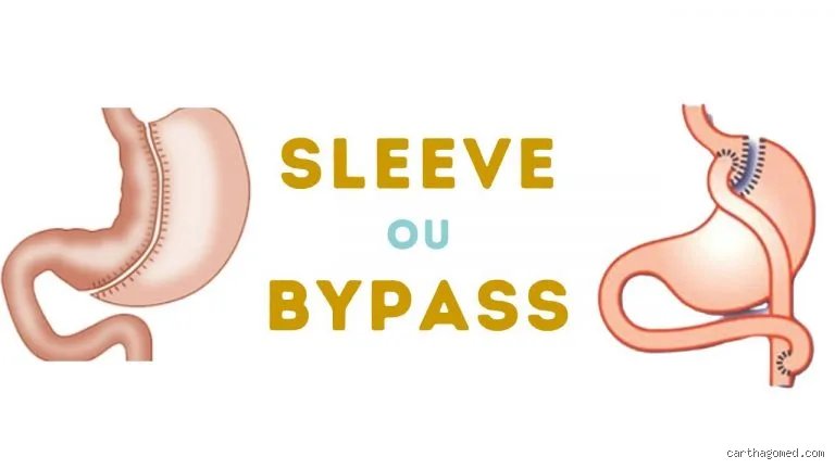 Comment ne pas payer une sleeve ?