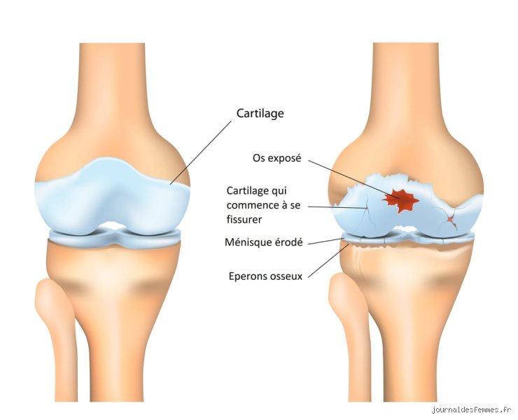 Comment régénérer naturellement le cartilage de mon genou ?