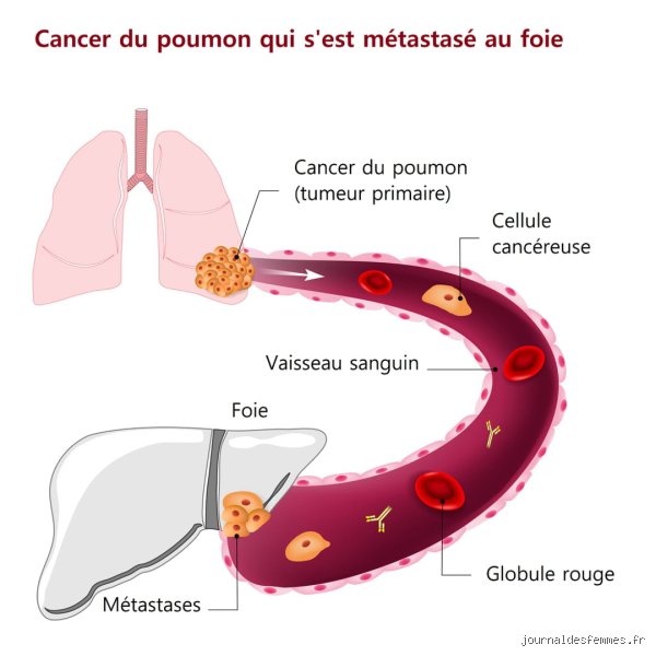 Comment ralentir la métastase du cancer ? Les nouvelles stratégies thérapeutiques qui bousculent l'oncologie moderne