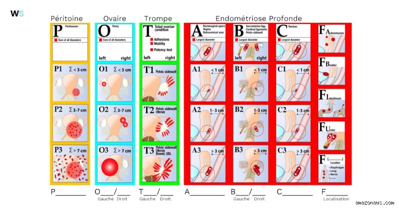 Comment savoir à quel stade de l'endométriose vous vous trouvez vraiment : le guide expert pour décrypter les classifications médicales actuelles