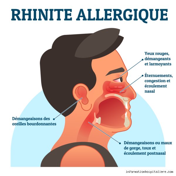 Comment savoir si c'est une rhinite allergique ?