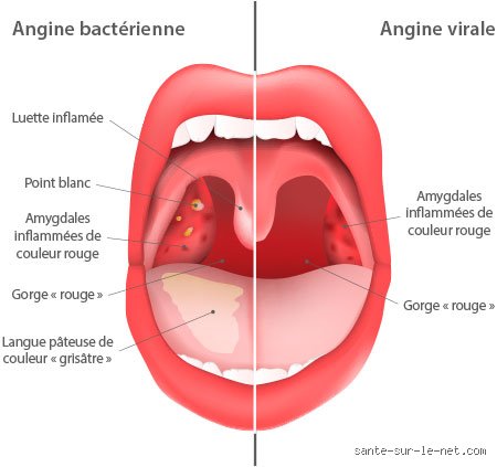 Comment savoir si j'ai une infection bactérienne ? Le guide complet pour distinguer le microbe du virus