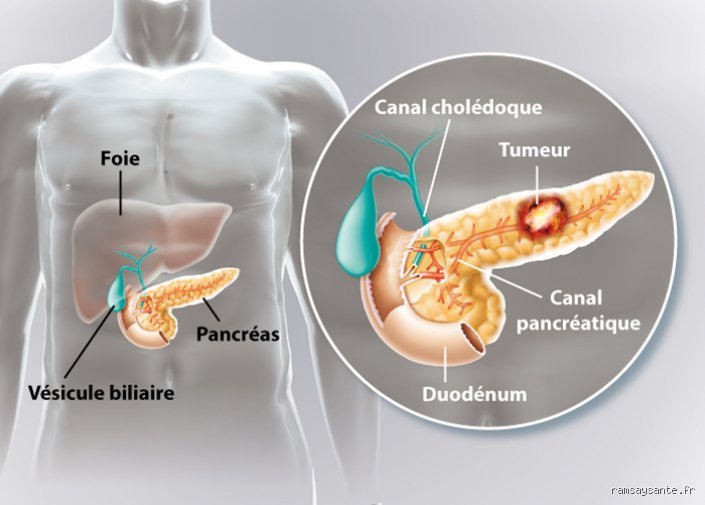 Comment savoir si la douleur vient de l'estomac ou du pancréas : le guide expert pour décrypter vos maux de ventre