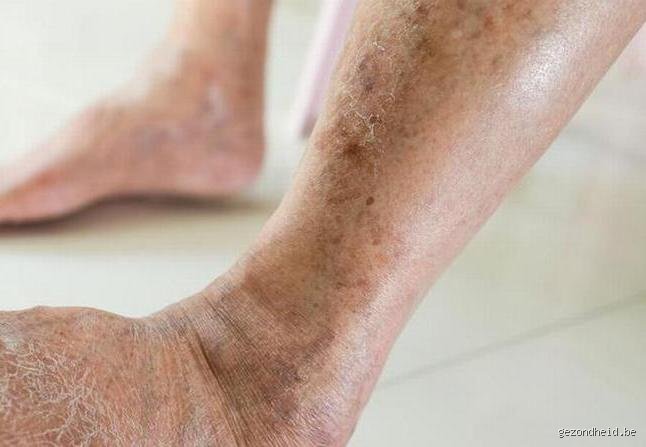 Comment savoir si le diabète affecte mes jambes : le guide complet pour repérer les signaux d’alerte invisibles
