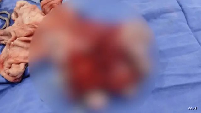 Comment savoir si on a un jumeau parasite : démêler le vrai du faux entre mythes médicaux et réalité biologique