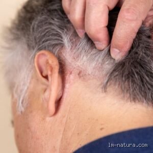 Comment savoir si on a une infection du cuir chevelu ?