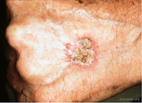 Comment savoir si votre carcinome épidermoïde s'est propagé ? Les signes d'alerte et les méthodes de diagnostic que vous devez connaître