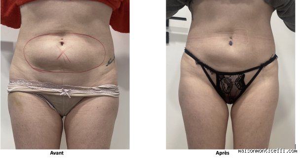 Comment se débarrasser de 9 kilos de graisse abdominale ?