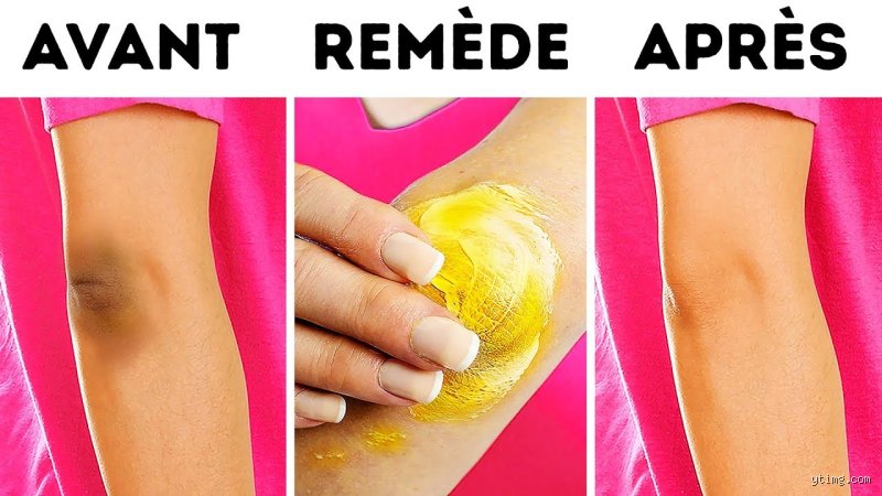 Comment se débarrasser de la corne sur les genoux : le guide complet pour retrouver une peau souple et dire adieu à la rugosité