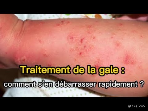 Comment se débarrasser de la gale une fois pour toute ?