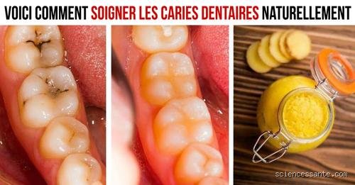 Peut-on vraiment soigner un trou dans une dent naturellement ? Mon approche honnête