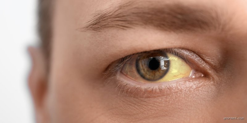Comment sont les yeux d'un alcoolique ?