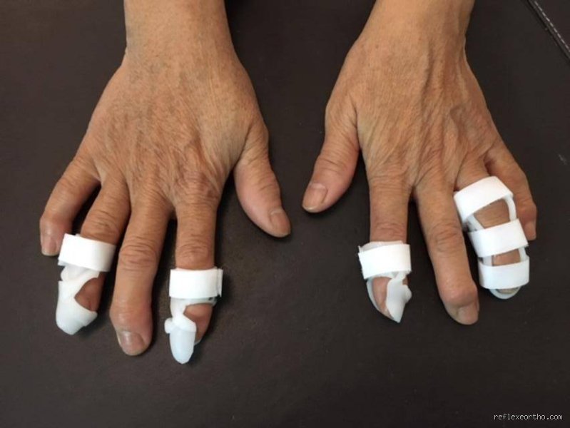 Comment stopper l'arthrose des doigts ?