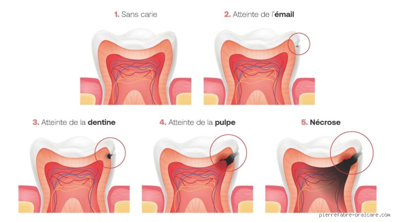 Comment stopper la progression d'une carie dentaire ?
