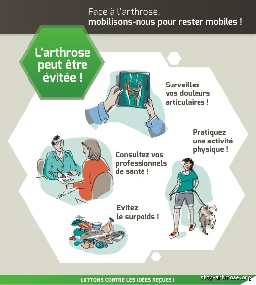 Comment stopper les poussées d’arthrose : les stratégies concrètes pour verrouiller l’inflammation et sauver votre cartilage