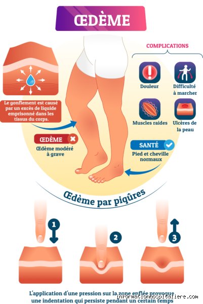 Comment vient l'œdème ? Cette question qu'on s'est tous posée un matin en voyant nos chevilles gonflées