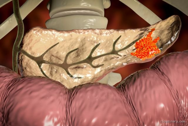 Comment voir le cancer du pancréas avec une prise de sang : la réalité brutale derrière les promesses de la biopsie liquide