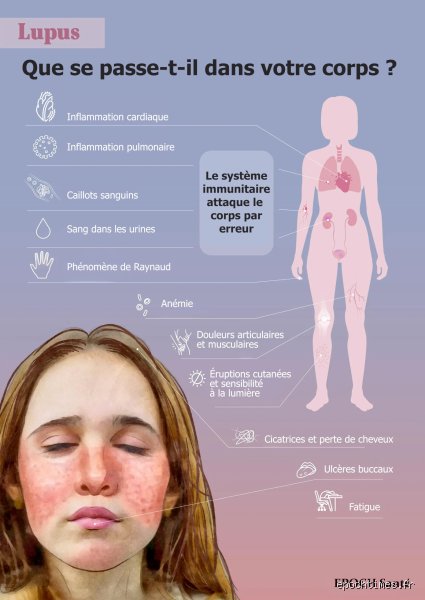 Comment votre vie change-t-elle lorsque vous êtes atteint de lupus : la réalité brutale derrière le diagnostic et les premiers bouleversements