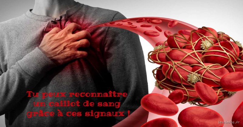 Est-ce qu'on peut sentir un caillot de sang ? La vérité sur la douleur et les symptômes silencieux