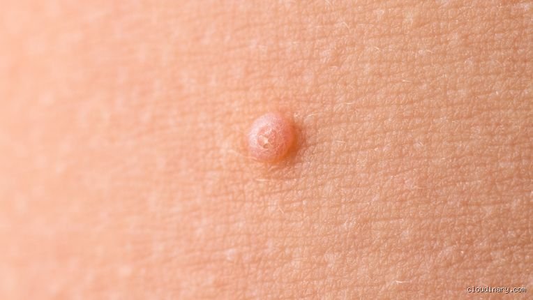 Est-ce qu'un nodule est un cancer ?