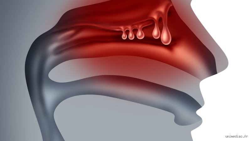 Est-ce qu'un polype nasal peut saigner ?