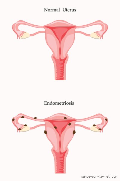 Est-ce que l'endométriose est reconnue par la MDPH ? Le guide complet pour faire valoir vos droits en 2026